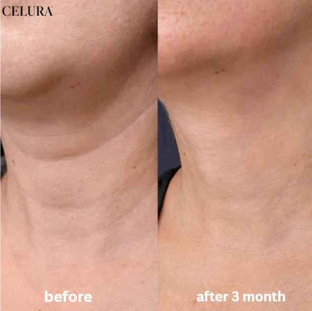 Celura Micro Infusion Skin Care